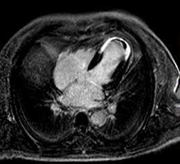 Herzinfarkt mit Thrombus